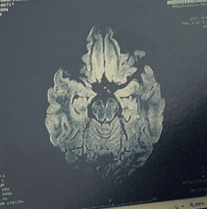 El cerebro de Rebeca antes de su cirugía
