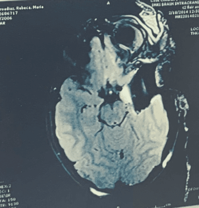 El cerebro de Rebeca después de extirparle el lóbulo temporal izquierdo