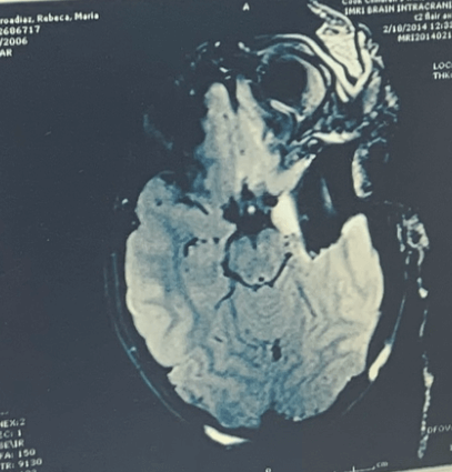 El Cerebro de Rebeca después de extirparle el lóbulo temporal izquierdo