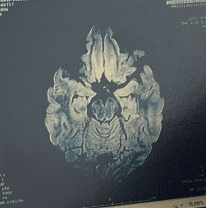 El Cerebro de Rebeca antes de su cirugía